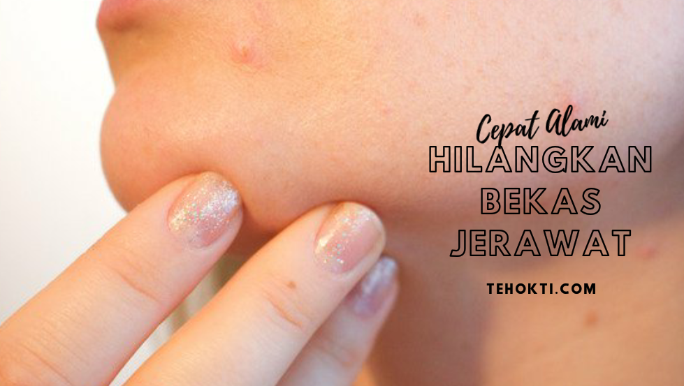Cara Cepat Alami Menghilangkan Bekas Jerawat